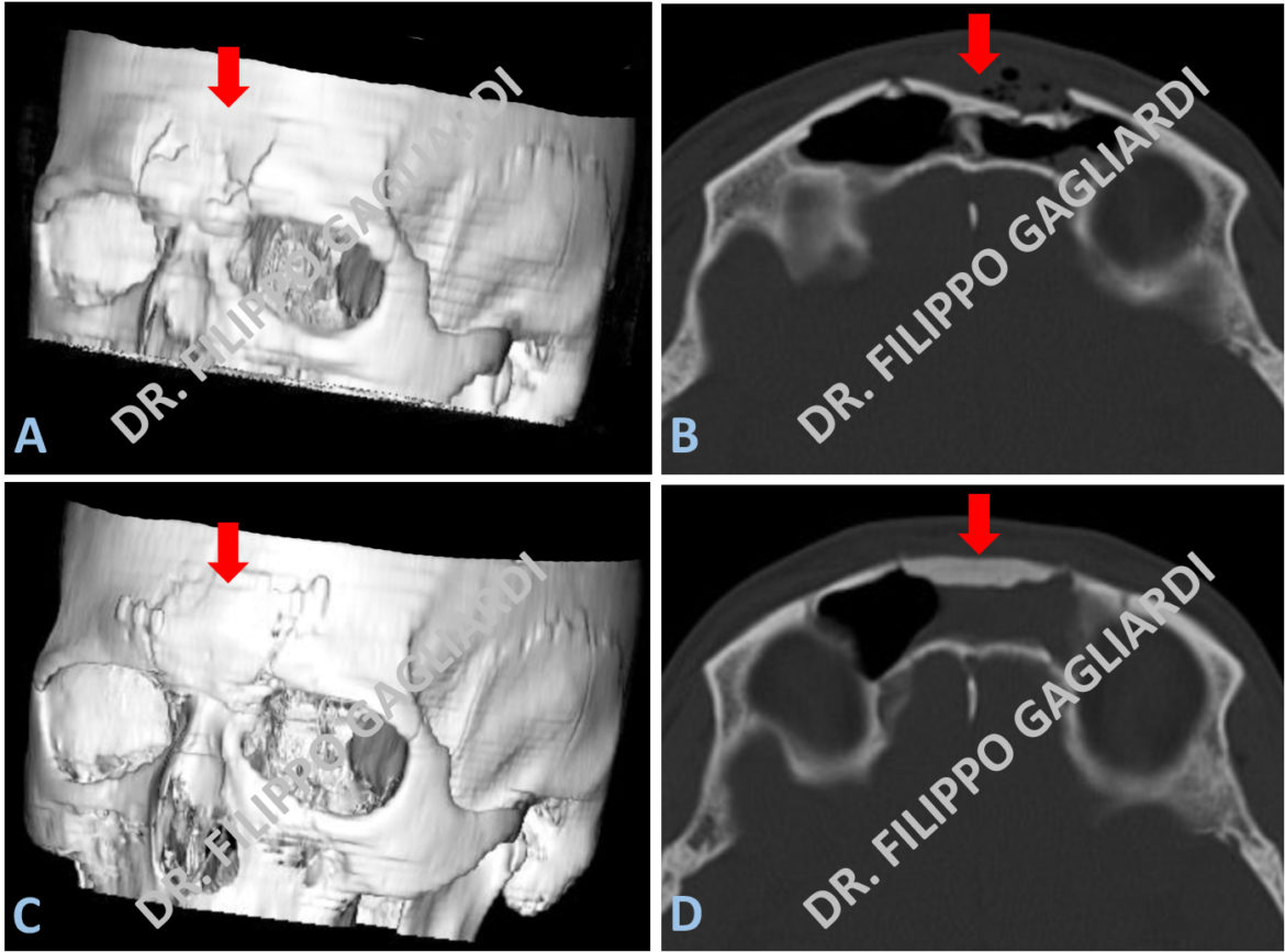 Patologia Traumatica Del Cranio Dott Filippo Gagliardi Neurochirurgo