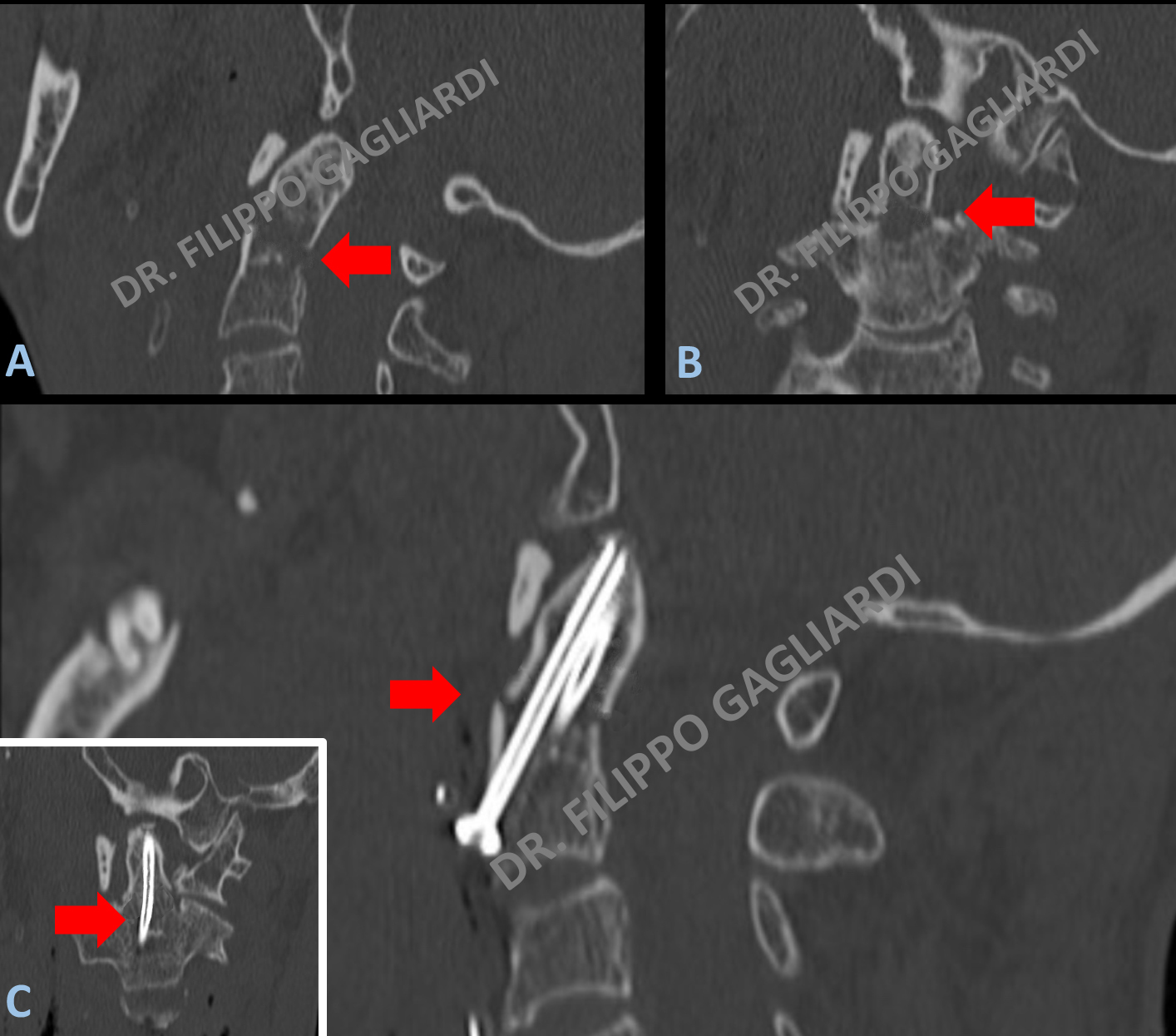 Stabilizzazione Cervicale Dott Filippo Gagliardi Neurochirurgo