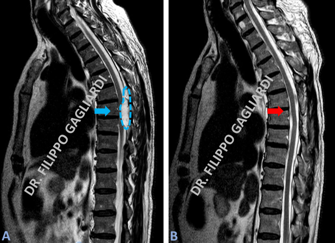 Tumori Spinali Dott Filippo Gagliardi Neurochirurgo