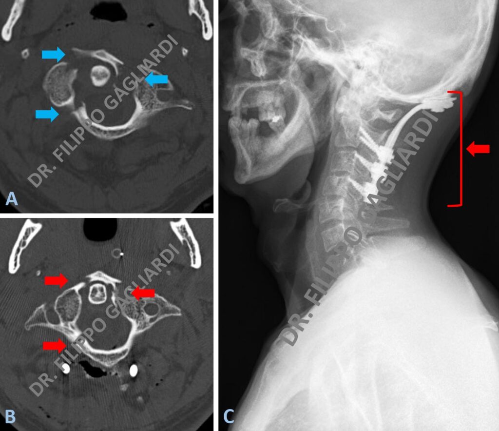 Patologie Traumatiche Del Rachide Cervicale Dott Filippo Gagliardi Neurochirurgo